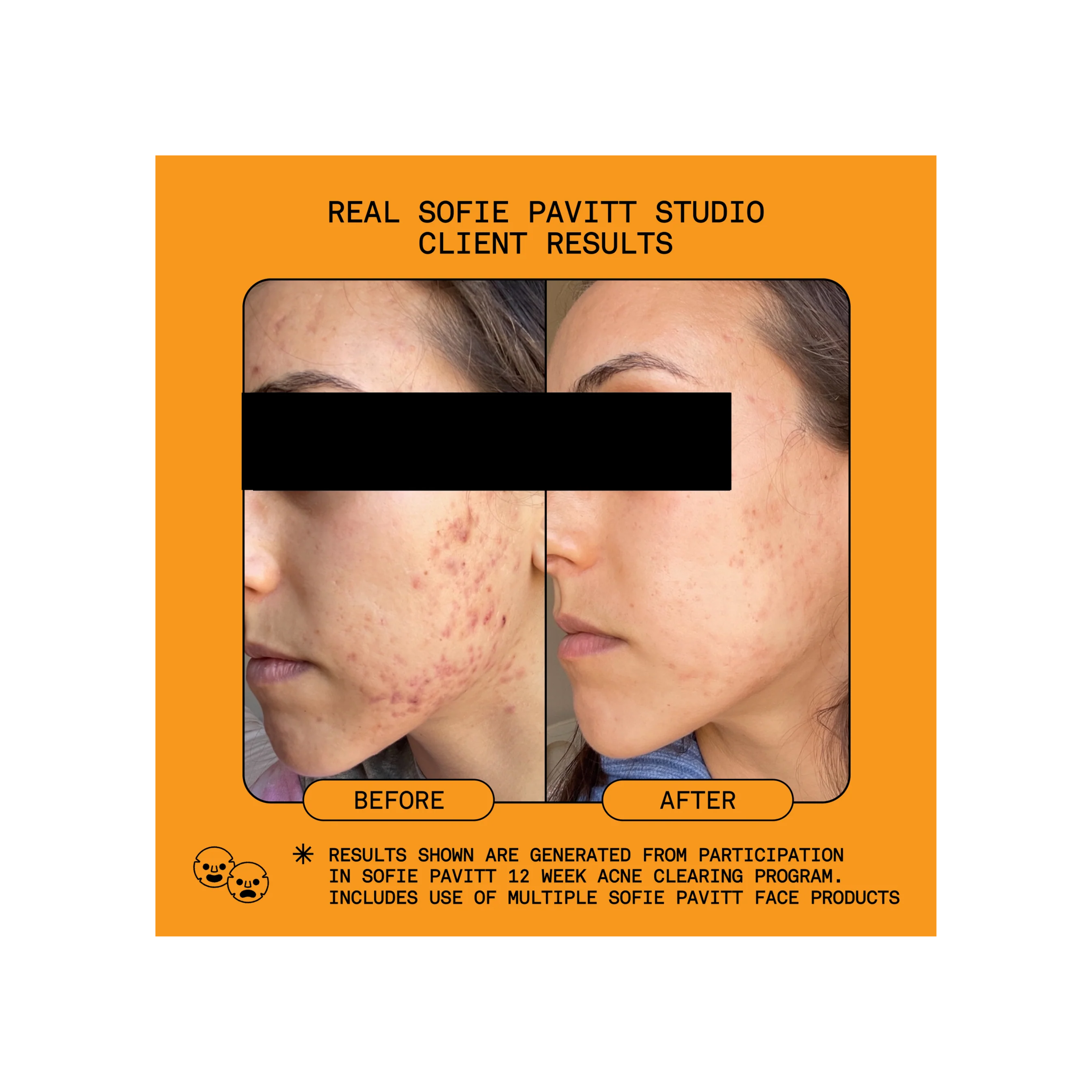 Reset 5% Benzoyl Peroxide Acne Treatment