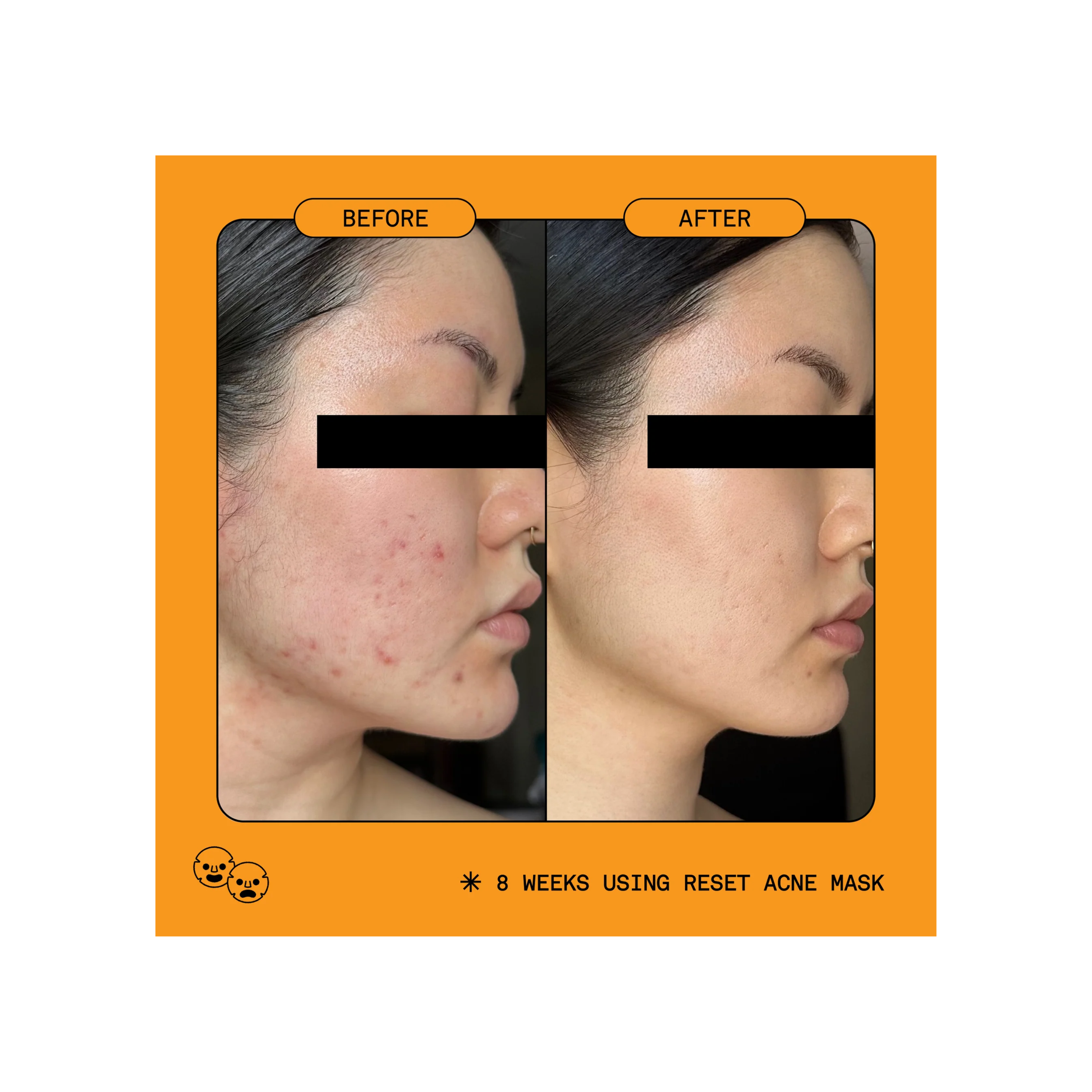 Reset 5% Benzoyl Peroxide Acne Treatment