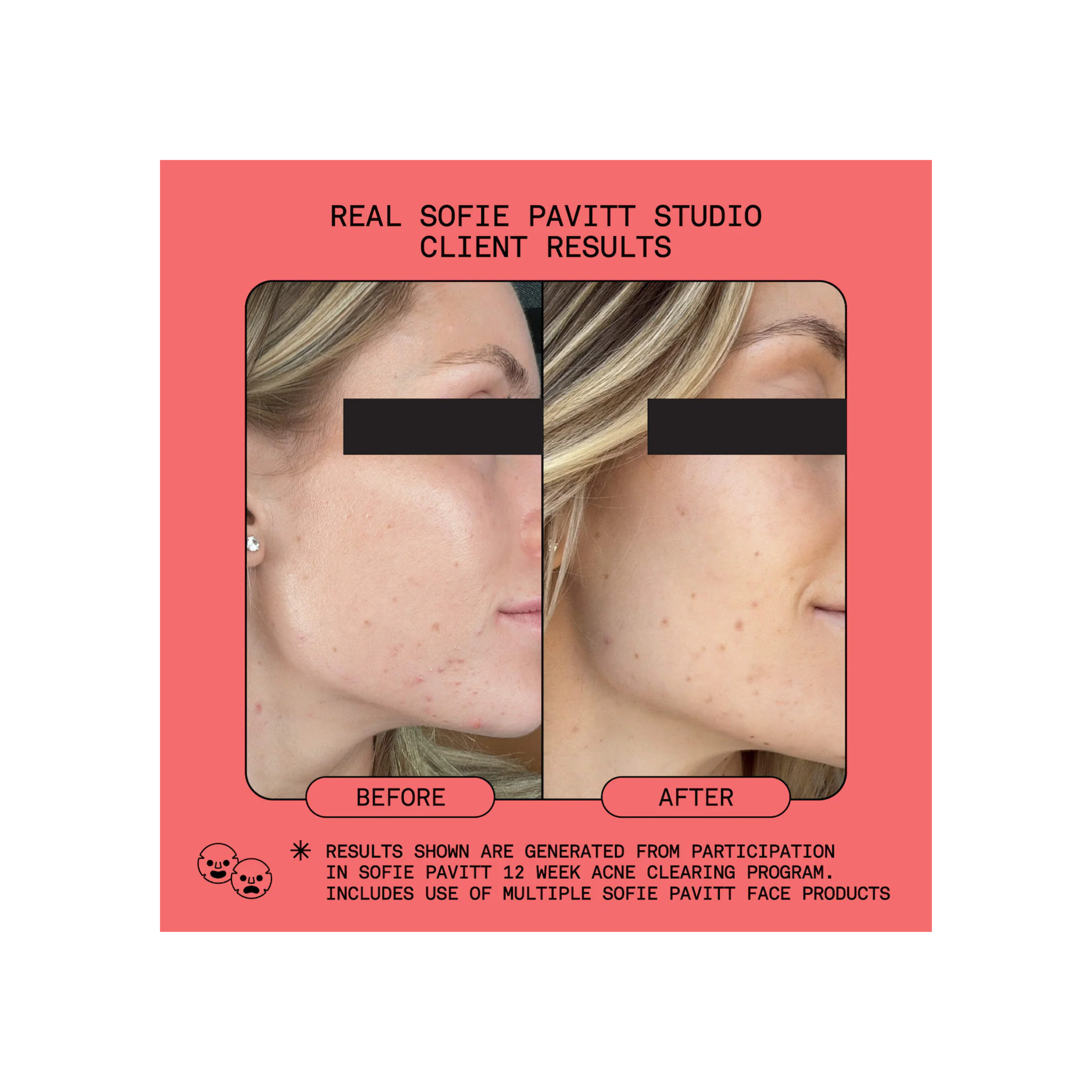 Studio-Smooth Microdermabrasion Treatment